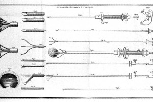 Instrumentos de litotrícia de Baron Heurteloup ©Wellcome Collection