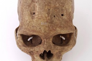 Um crânio humano mostrando sinais de trepanação ©Wellcome Collection