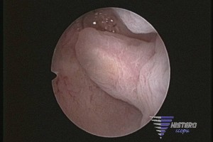 Pólipo endometrial - Aspeto Histeroscópico ©histeroscopia.es