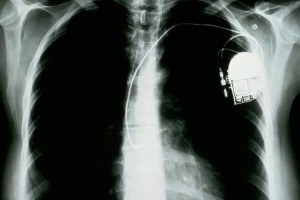 Pacemaker ©Wellcome Collection
