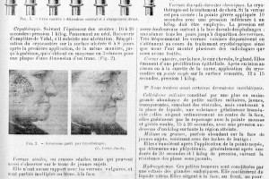 Fig. 1. Criocautério / Fig.2. - Lesões tratadas com crioterapia (L. Lortat-Jacob) ©Le progrès médical, 1923 |Bibliothèque Interuniversitaire de Santé (Paris)